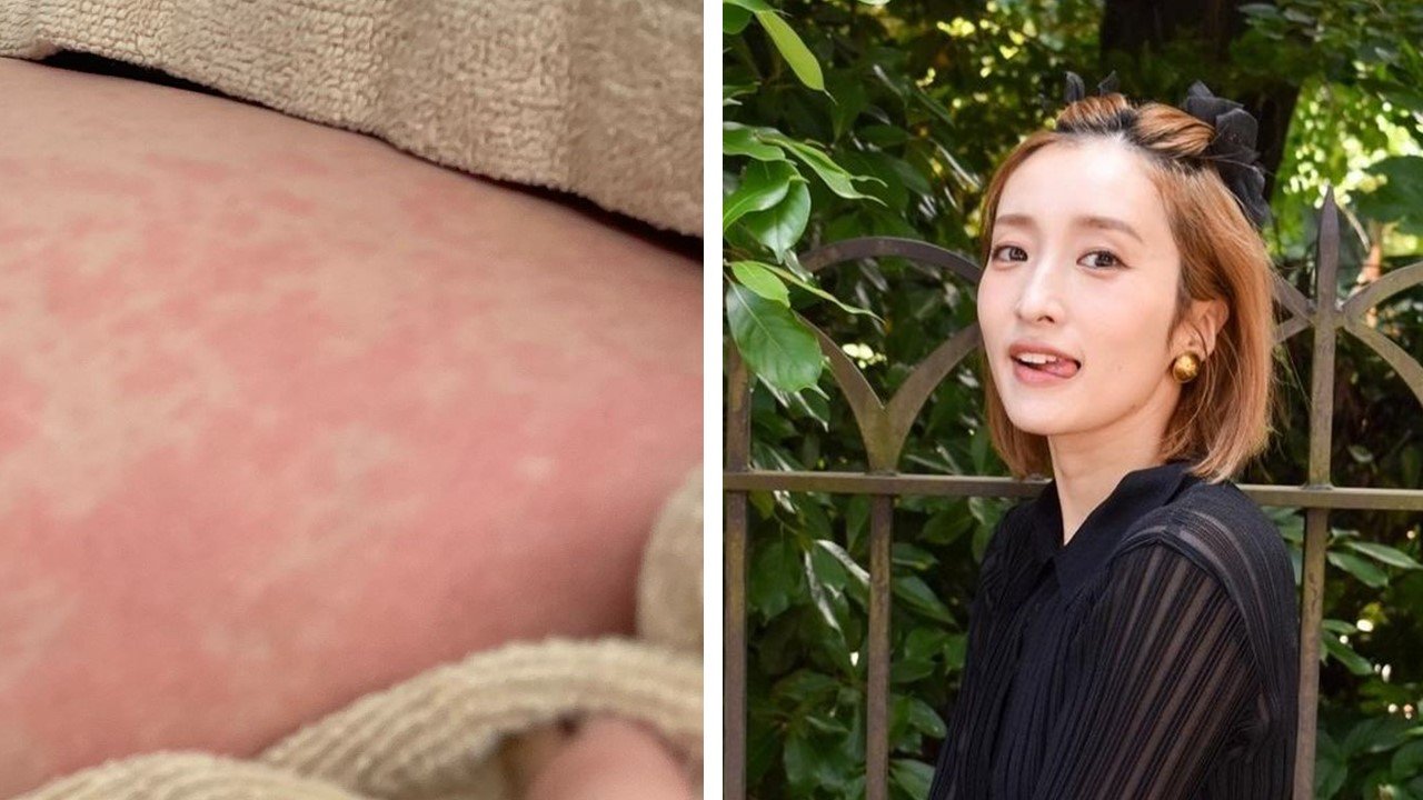 元AKB48梅田彩佳】原因不明 じんましん写真投稿「全身。顔にも。熱も出