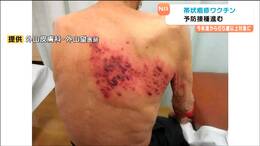 「下着が触れるだけでびりびり」帯状疱疹の恐怖 65歳以上に予防接種開始される どんな人が対象なのか?その費用は…?|TBS NEWS DIG