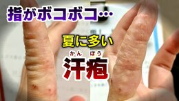 気がつくと指がボコボコに…1本の指に数十個の“水ぶくれ” 夏に増える「汗疱(かんぽう)」とは? 水虫との違いや予防策を医師が解説|TBS NEWS DIG