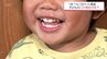 お口がぽかん  子どもの口腔機能発達不全症が全国で増加 昔ながらの遊び減少も原因に|TBS NEWS DIG