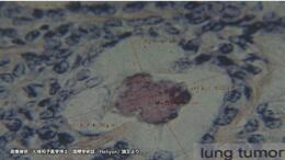 広島原爆の入市被爆者　70年後の体内からウラン検出　肺がん組織では「デスボール」確認　長崎大学研究グループ|TBS NEWS DIG