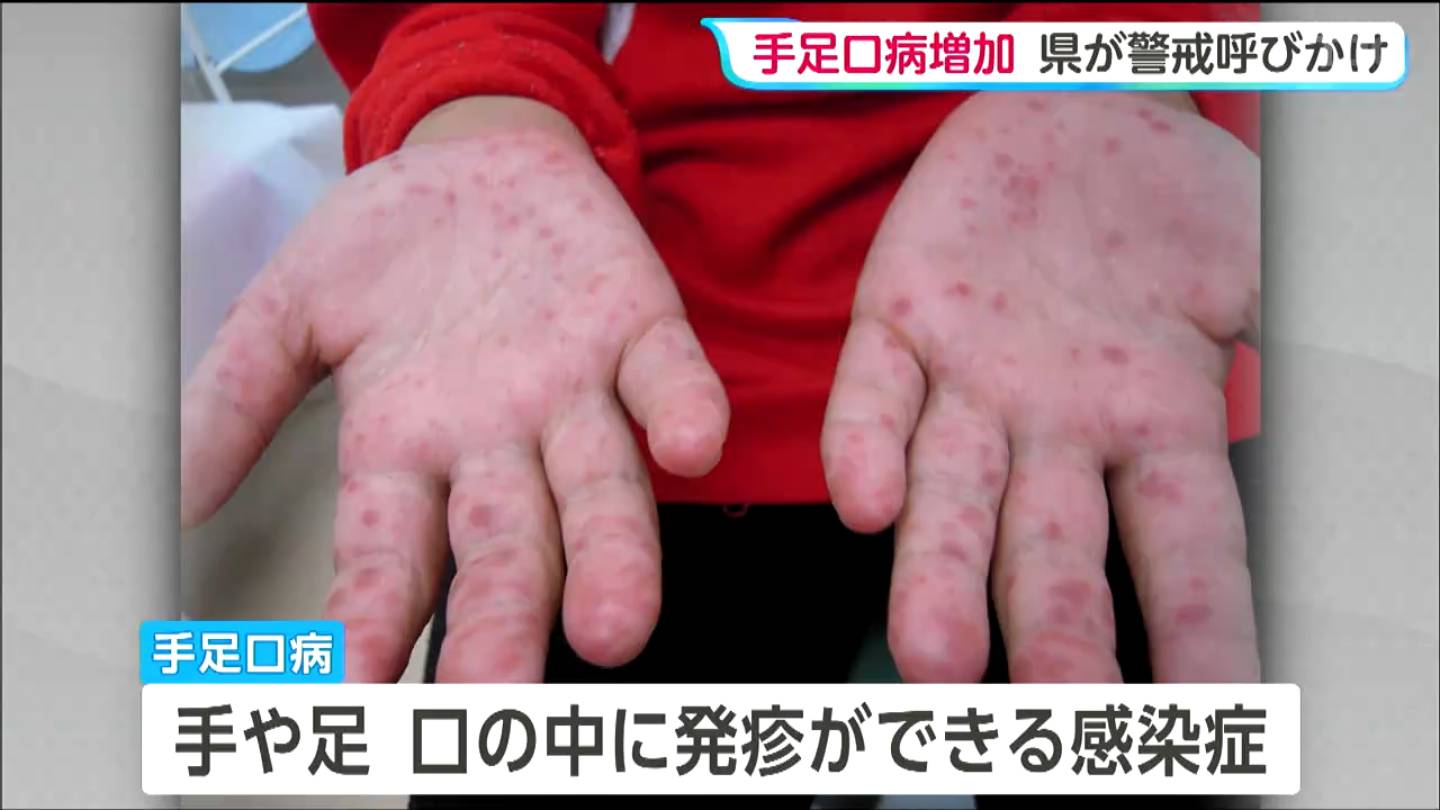 宮城県内の手足口病感染者数 定点医療機関1か所あたり8.29人と前の週