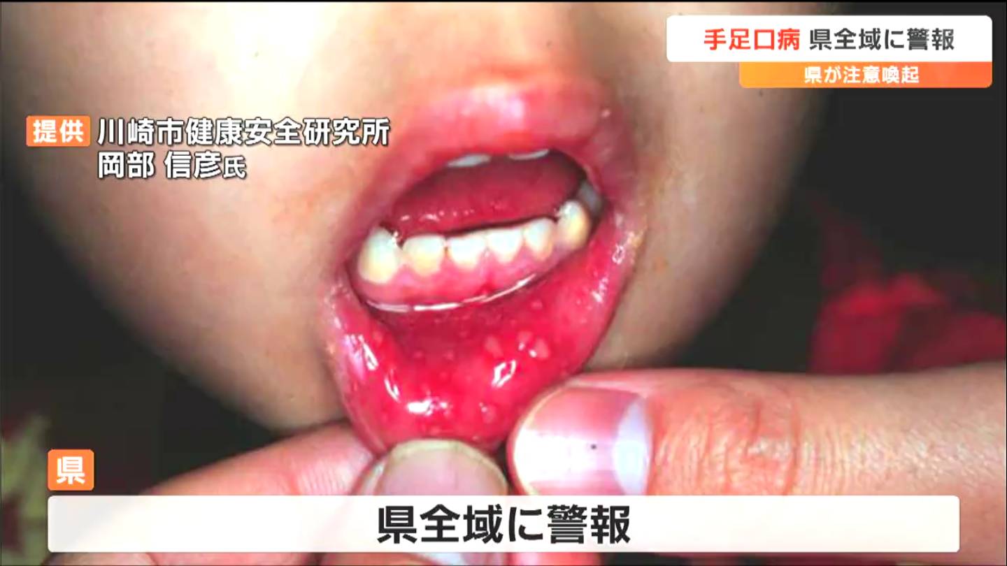 手足 口 病 口 の 中