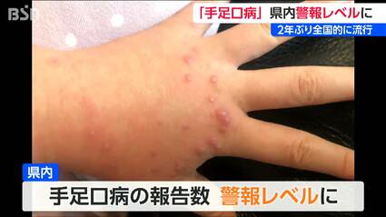 手足口病 2年ぶり流行し警報レベルに 国の警報基準5を超える 新潟県